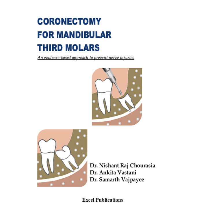 Buy Coronectomy For Mandibular Third Molars